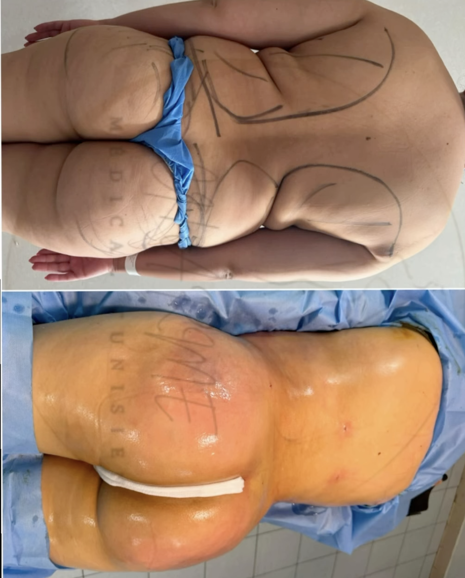 Résultat avant / après — Lipofilling des fesses (BBL)