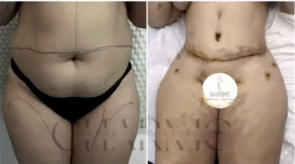 Résultat avant / après — Abdominoplastie avec liposuccion